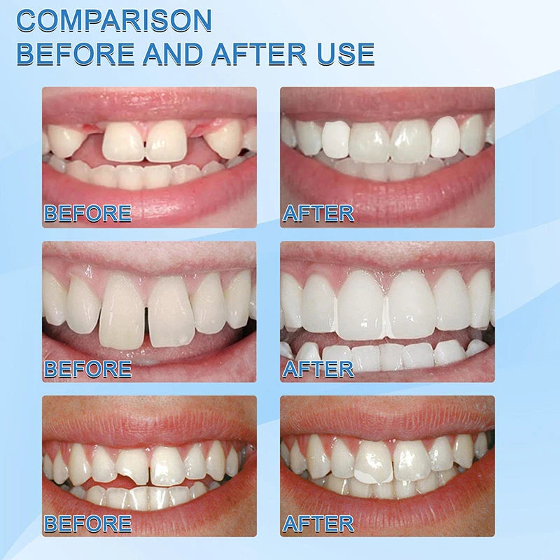 Resin Temporary Tooth Repair Glue – Moldable Dental Filler - EverGrowMarkeplace